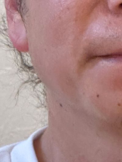 施術後（あご）