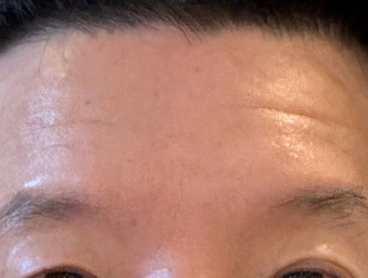 施術後（おでこ）