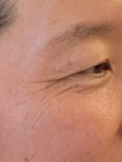 施術前（目尻）