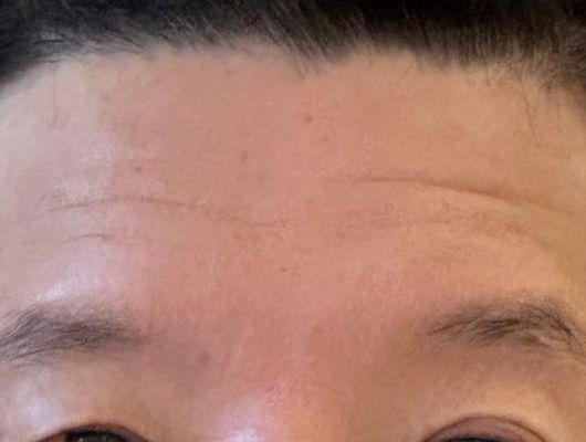 施術前（おでこ）